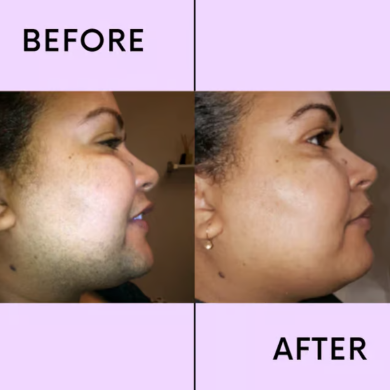 SmoothEase - Facial Hair Removal Cream Duo