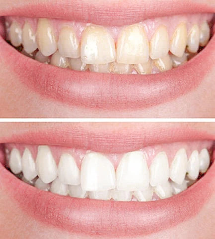 LuminiWhite — Teeth Whitening Pen for Brighter Looking Teeth