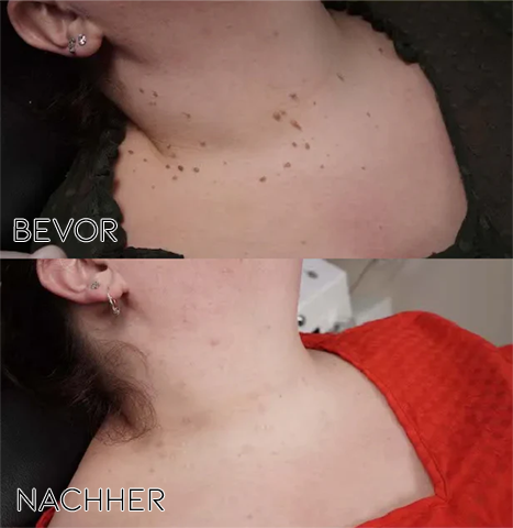 GlowQuell — Lápiz removedor de precisión para etiquetas cutáneas y lunares