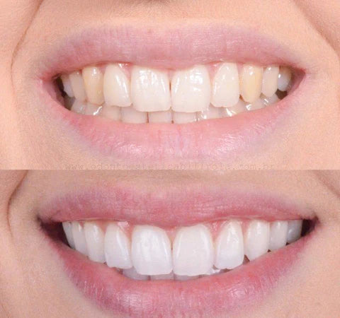 LuminiWhite — Teeth Whitening Pen for Brighter Looking Teeth