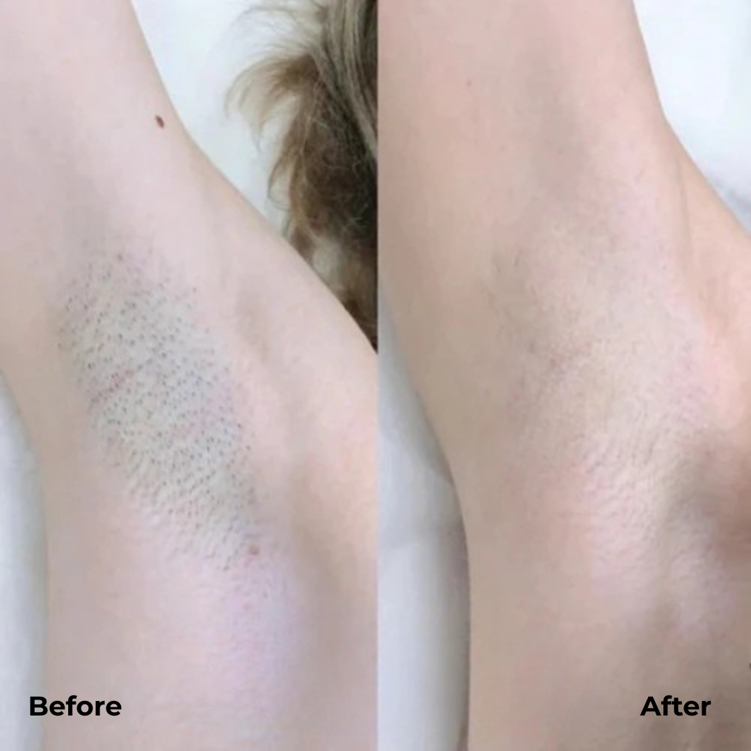 SilkTrim Pro - Electric Hair Trimmer for Smooth, Gentle Hair Removal