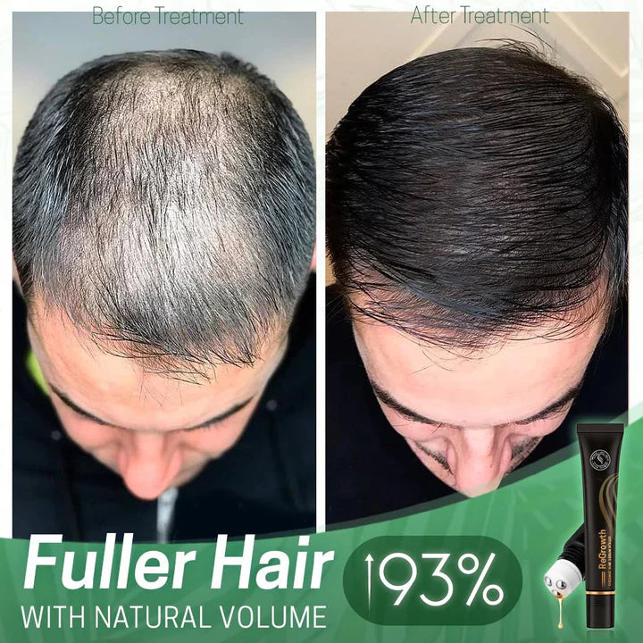 StrandSurge Serum — Hair Growth Serum with Roller Applicator