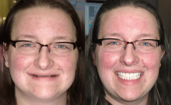 Comfort-Fit Cosmetic Dentures – Removable Smile Set