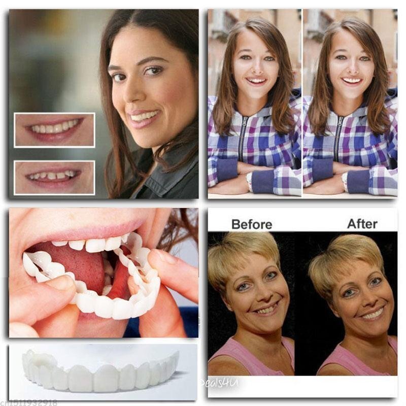 Snap-On - Clip-On Cosmetic Smile Cover