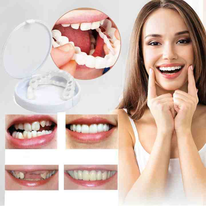 Snap-On - Clip-On Cosmetic Smile Cover