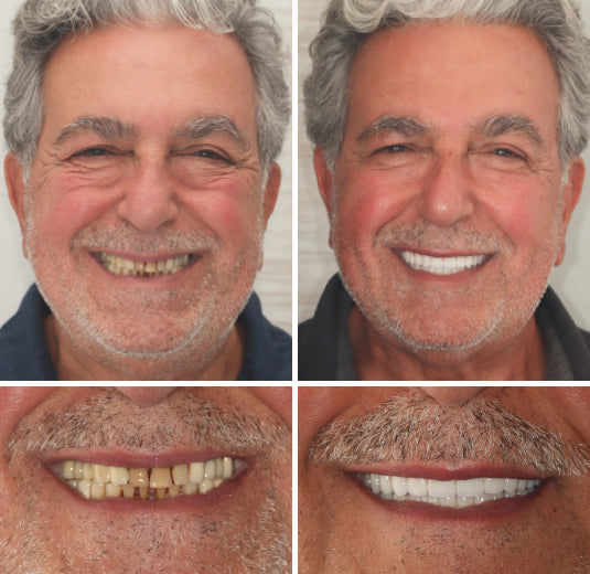 Comfort-Fit Cosmetic Dentures – Removable Smile Set