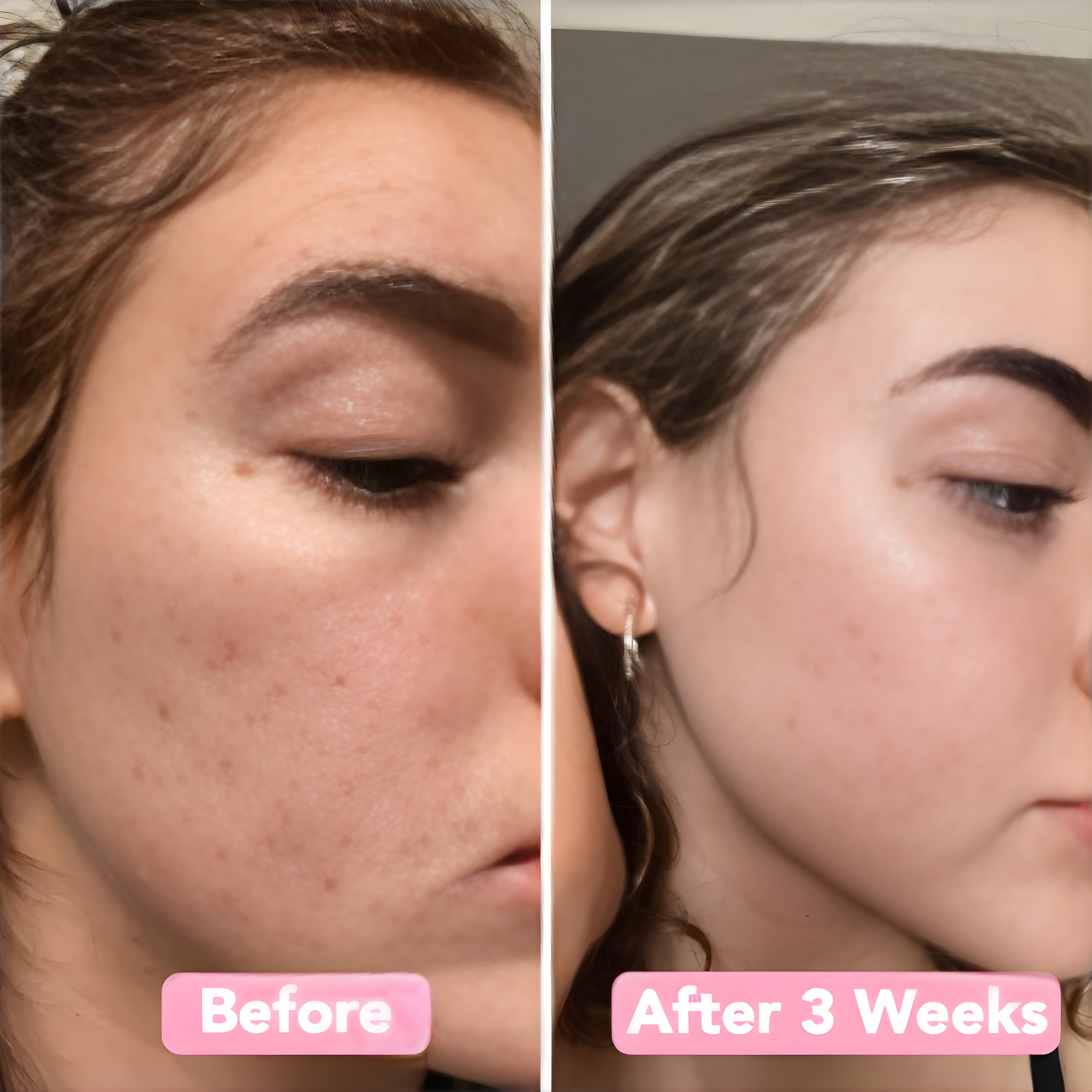 Discos iluminadores LumaSkin — discos exfoliantes para el rostro