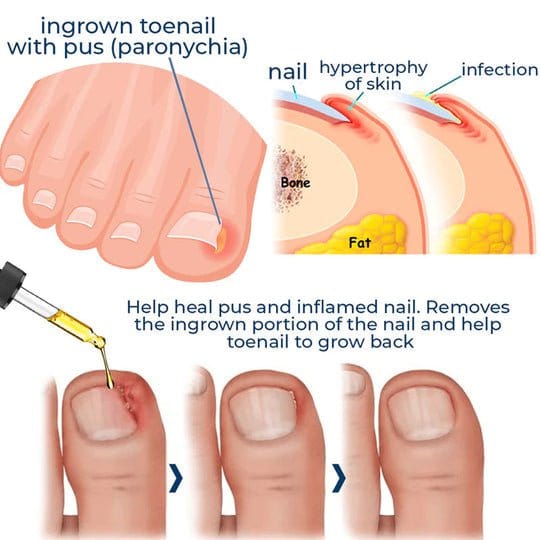 ToenailPlus - Anti-Paronychia Ingrown Toenail Care Oil